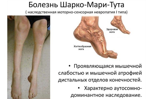 Болезнь шарко мари тута: причины, 8 симптомов, 3 метода лечения Болезнь шарко мари тута: причины, 8 симптомов, 3 метода лечения