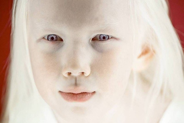 Альбинос: кто такой, 3 типа альбинизма, способы лечения и советы Альбинос: кто такой, 3 типа альбинизма, способы лечения и советы
