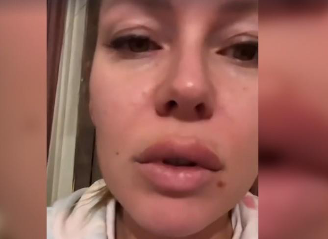 Рита Дакота сделала процедуру по увеличению губ и осталась недовольна