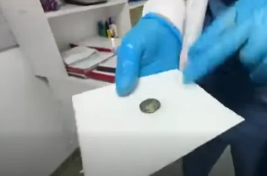 Ребенок проглотил батарейку: врачи НЦОМИД спасли жизнь малышке